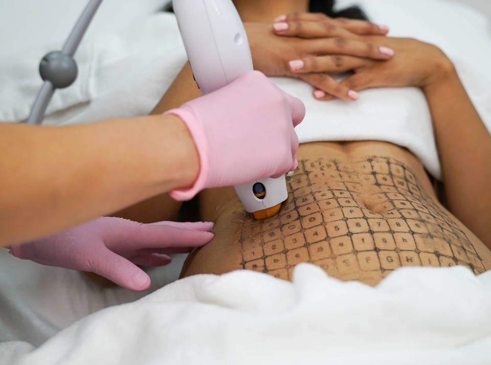 Thermage FLX Image