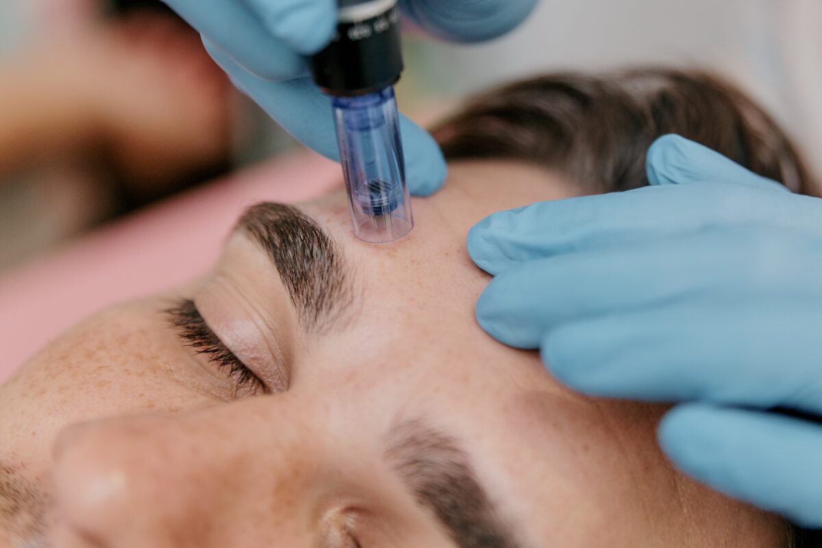 microneedling benefits