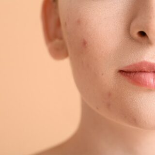 Acne