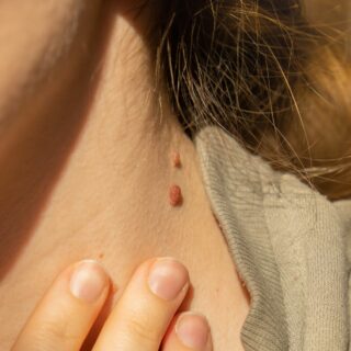 skin tag removal london