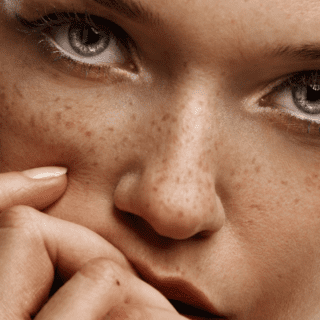 skin pigmentation hyperpigmentation