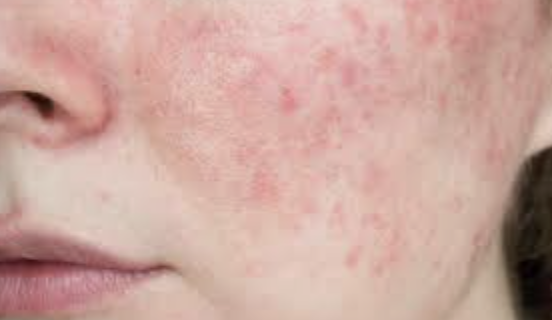 Is Laser Treatment effective for Rosacea?