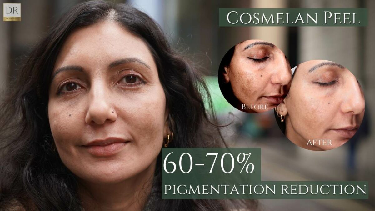 Derma Revive Transformations: Cosmelan Peel
