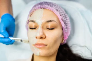 acne peel london