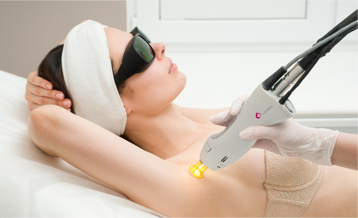 candela laser hair removal london