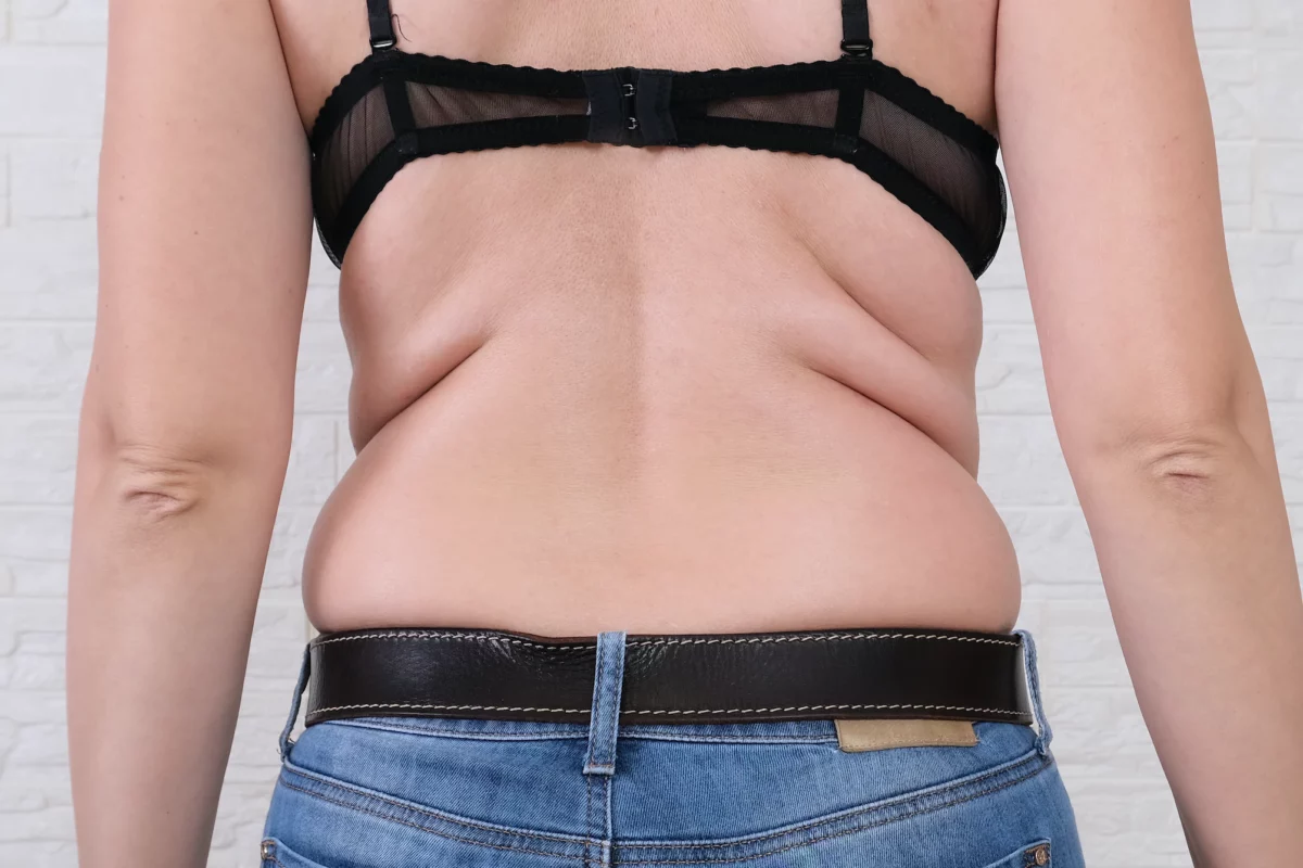back fat coolsculpting
