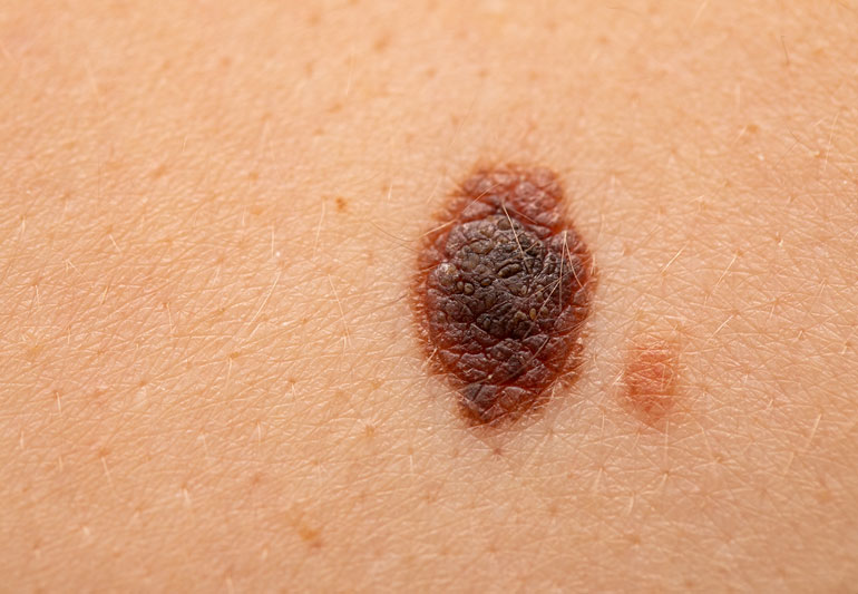 cosmetic mole removal