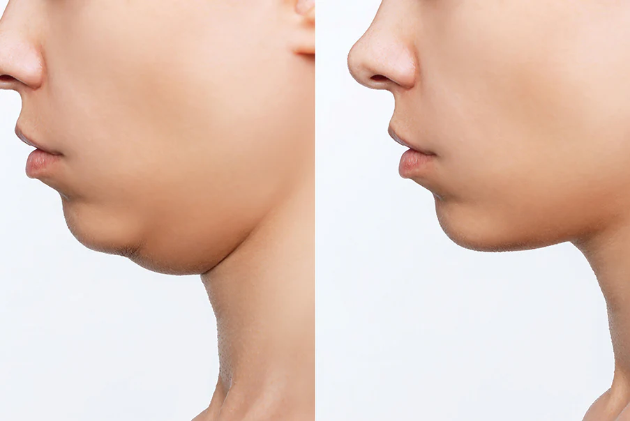 CoolSculpting for Double Chin