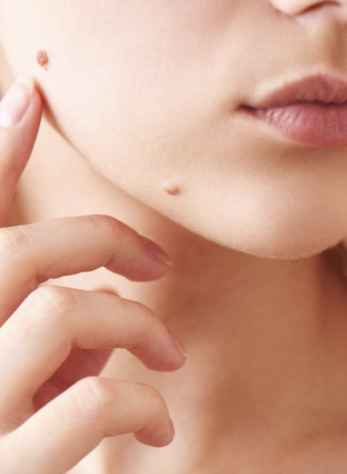 Mole Removal Image