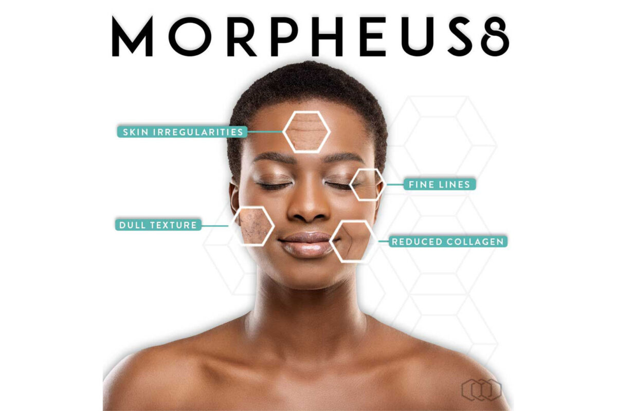 morpheus8 london