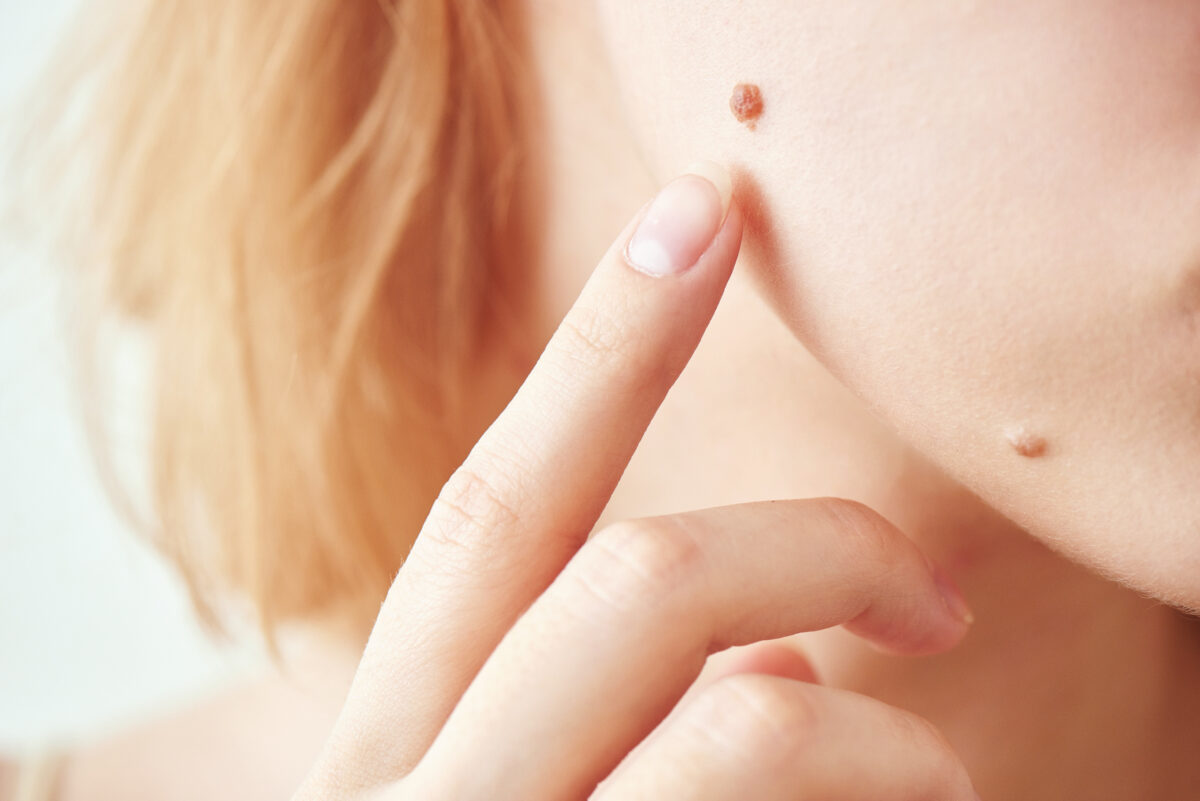 the mole on the girl's face closeup