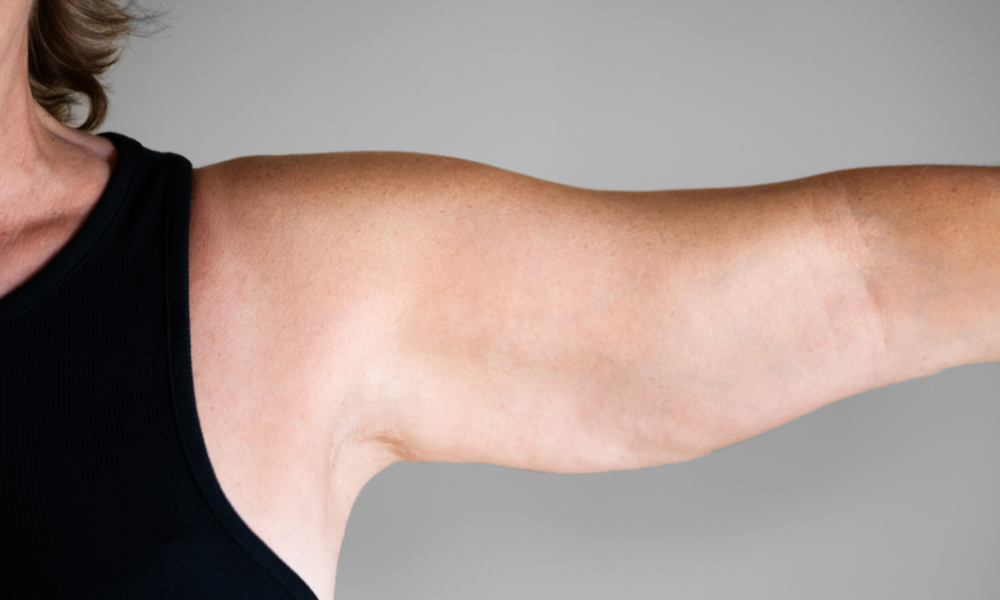 coolsculpting for arms