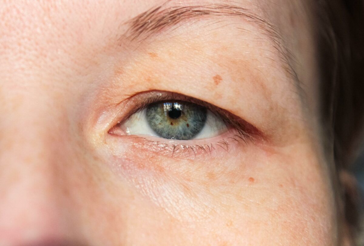 double eyelid