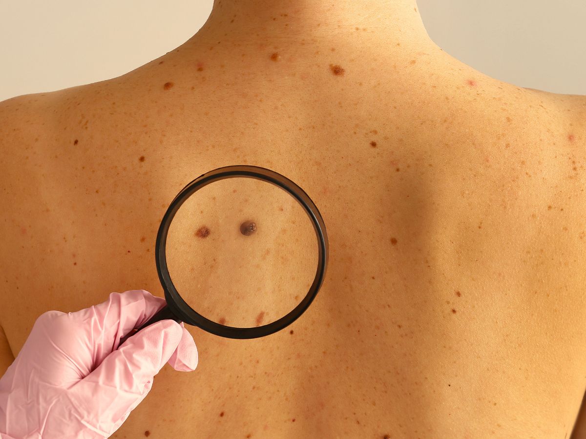 mole on human skin