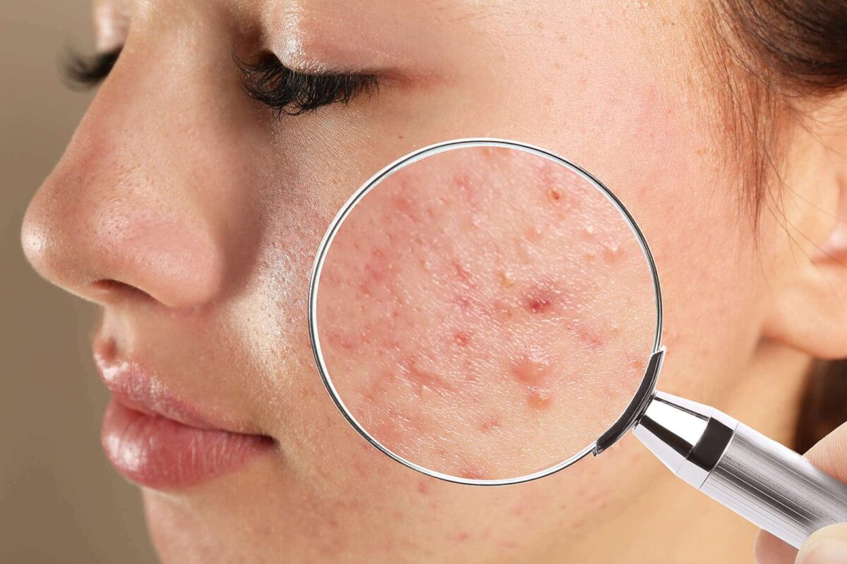 abcs of acne