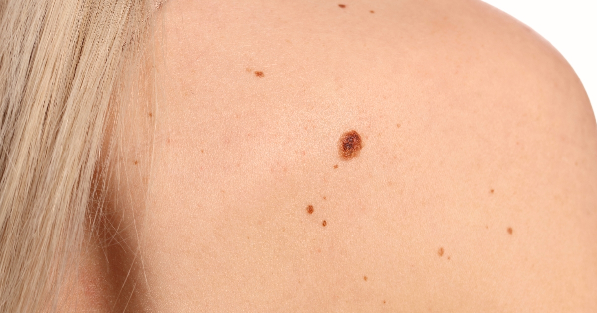 skin lesion treatment