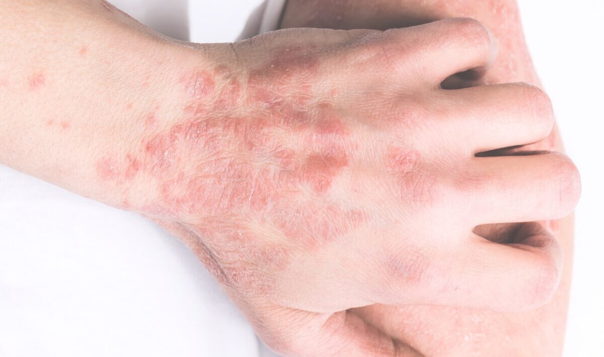 psoriasis treatments in london