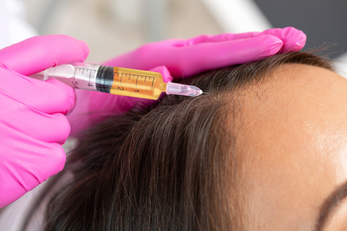 prp hair loss