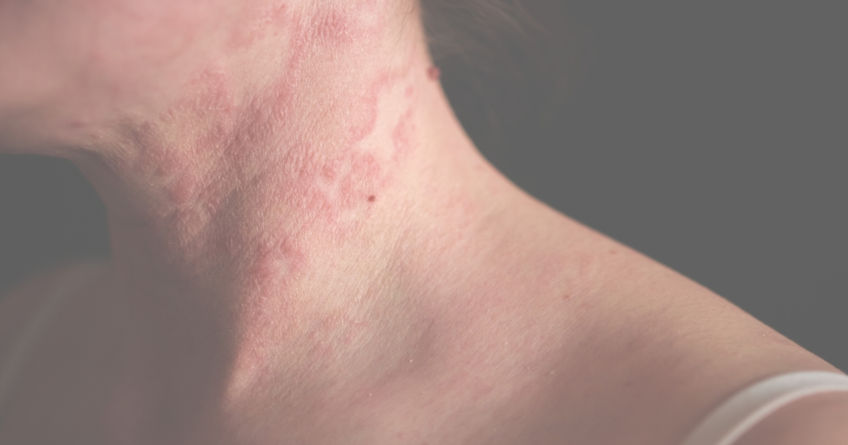 LED Light Therapy For Eczema