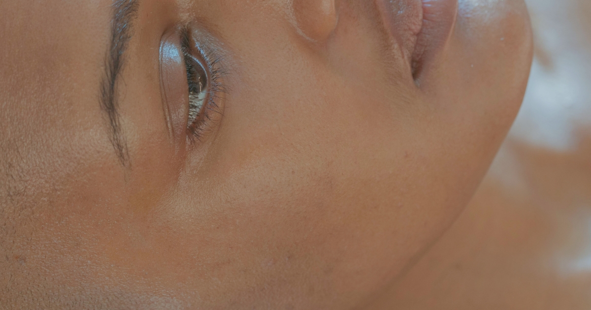 acne laser treatment london