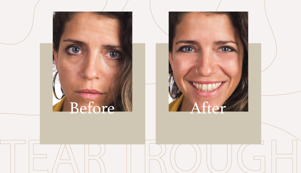 Are Tear Trough Fillers the Answer to Dark Circles?