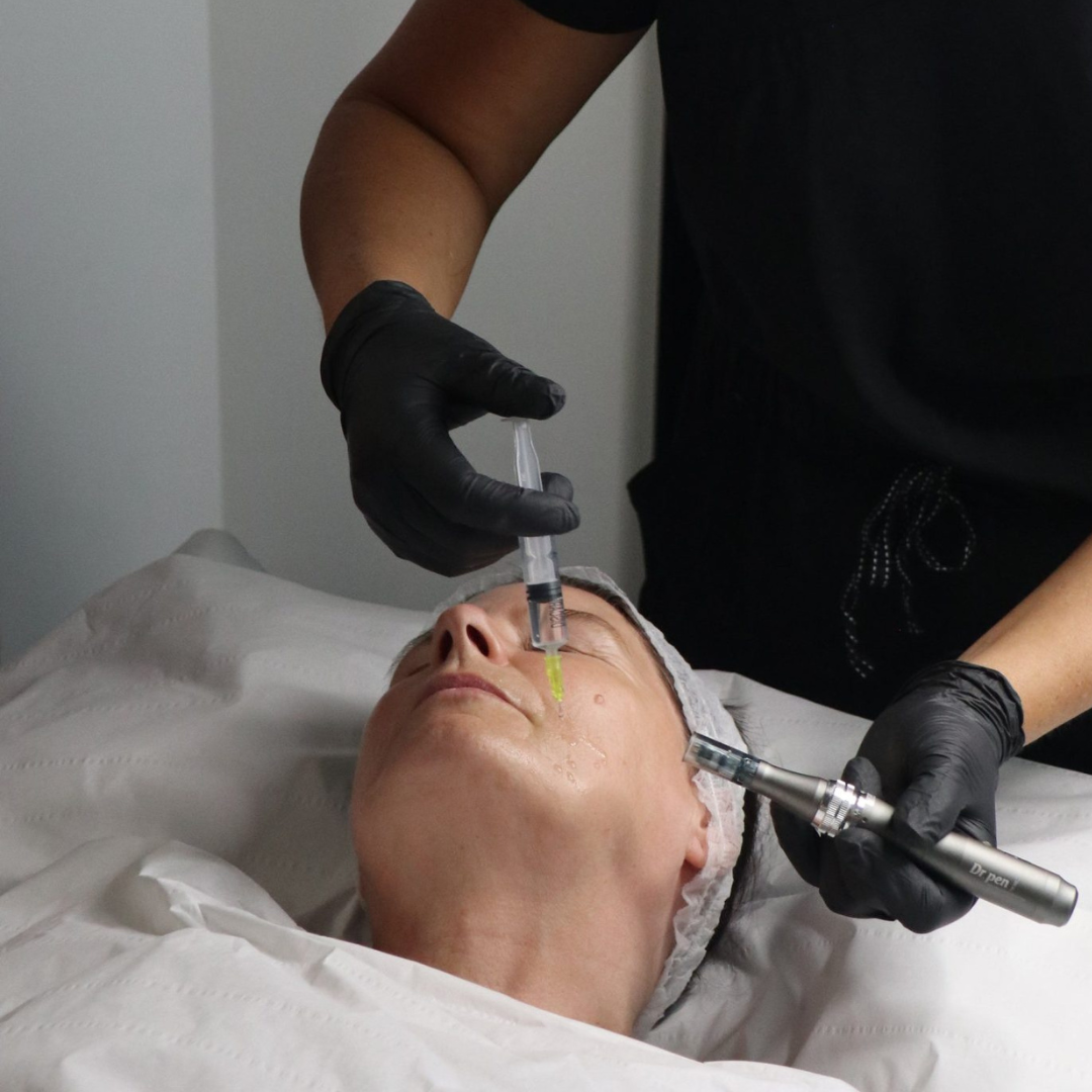 Exosome Microneedling Treatment in London